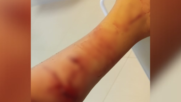 Criança de 3 anos é atacada por cachorro a caminho da creche em&nbsp;SC