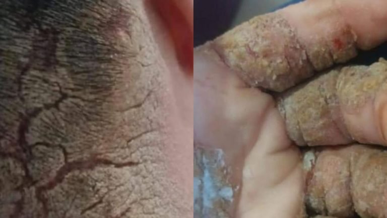 Família pede ajuda para tratar doença de pele rara em adolescente com síndrome de Down em SC